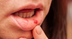 Afta na boca: estresse, falta de vitamina ou algum problema de saúde?
