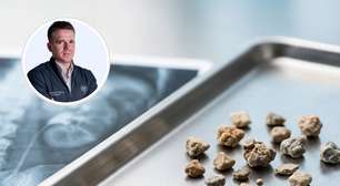 Pedra no rim de 5 mm sai sozinha? Urologista explica quando esperar e quando operar