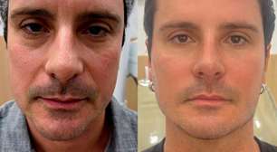 Ex-galã de 'Malhação', Sérgio Abreu surge com novo visual após harmonização facial
