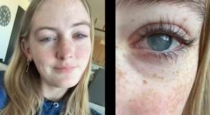 Jovem de 19 anos perde a visão dos dois olhos após tomar banho com lente de contato