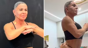 Gretchen faz procedimentos no rosto e no corpo após transplante capilar: 'Resultado incrível'