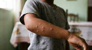 Molusco contagioso na pele: como pega e quando é preciso se preocupar