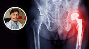 Osteoporose: "nossos ossos não costumam avisar quando estão ficando mais frágeis"