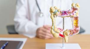 Pólipos intestinais: causas, sinais e prevenção do câncer colorretal