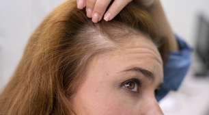 Queda de cabelo na menopausa: conheça a solução