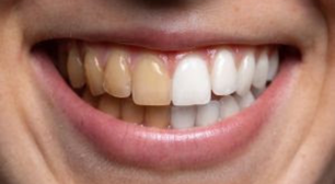 Energéticos: como o consumo pode afetar a saúde dos dentes?