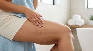 Pelos encravados: como evitar, tratar e conquistar uma pele lisinha após a depilação