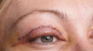 Blefaroplastia: 6 mitos e verdade sobre a cirurgia