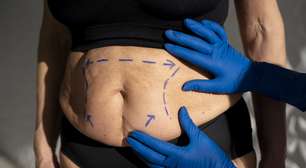Mini lipoaspiração promete recuperação mais rápida; entenda