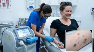 Clínica aumenta a intensidade do laser durante uma sessão de depilação, cliente sente fortes dores e depois aparecem queimaduras e manchas; um ajuste inadequado no equipamento pode terminar em tratamento médico e indenização