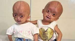 Qual é a doença das gêmeas Elis e Eloá Lima? Entenda a síndrome que levou à morte da influencer mirim