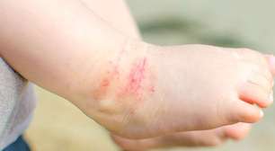 Dermatite atópica: como identificar os sinais em bebês