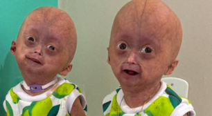 O que é a 'síndrome de Benjamin Button', que vitimou gêmea aos 5 anos em Roraima