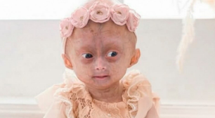 Quem era a gêmea brasileira com 'Síndrome de Benjamin Button' que morreu em Roraima