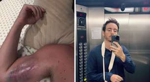 Ator da Globo Wagner Santisteban mostra hematomas após acidente na academia: 'Doendo muito'