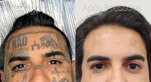 Remoção de tatuagem cresce e muda perfil de quem procura