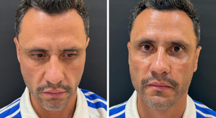 Cleitinho passa por nova harmonização facial um dia após ser eleito governador de Minas Gerais