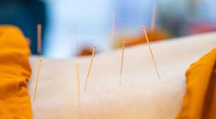 Acupuntura auxilia no alívio de sintomas da quimioterapia, apontam estudos