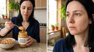 As espinhas apareceram depois de comer amendoim ou pasta de amendoim: coincidência ou sinal de que algo pode estar influenciando sua pele?