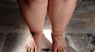Obesidade infantil: como prevenir e entender os desafios além da alimentação