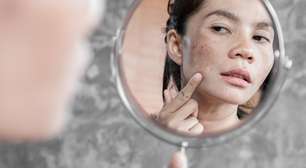 Melasma: cuidados essenciais para evitar manchas mais escuras