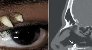 Adolescente tinha dente na região do olho e outros casos foram encontrados no nariz. Por que isso acontece?