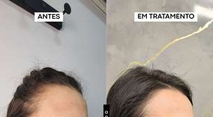 Nevo de Ota pode ser tratado com laser, explica biomédico