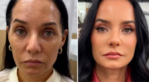 Harmonização facial: antes e depois de Mônica Carvalho chama atenção