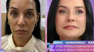 Aos 55 anos, Mônica Carvalho faz harmonização facial e mostra antes e depois