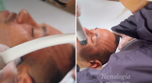 Neymar faz tratamento dermatológico com tecnologia de radiofrequência; saiba como funciona