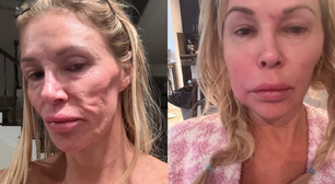 Estrela de reality show revela que vai 'tirar o rosto fora' para investigar suposto parasita