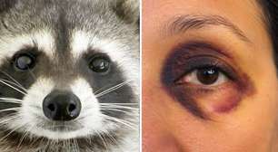 Atenção aos olhos de guaxinim: eles surgiram do nada em mulher de 60 anos e revelaram uma doença rara que pode comprometer o coração e os rins