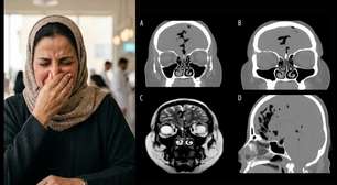 Segurar o espirro faz mal? Mulher de 45 anos descobre ar dentro do crânio