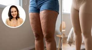 A cirurgia do lipedema acabou. Por que a recuperação ainda exige tantos cuidados