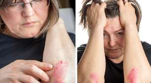 Dia Mundial da Psoríase: não é contagiosa, mas pode afetar a pele, as unhas, as articulações e a saúde emocional
