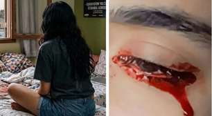 Adolescente chorava sangue durante a menstruação e médicos suspeitaram de endometriose