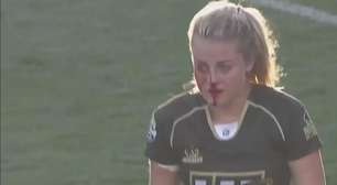 Australiana quebra nariz, segue em jogo de rúgbi e vira hit