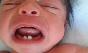 Bebê nasce com dentes e faz extração 10 dias após parto