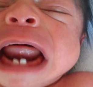 Bebê nasce com dentes e faz extração 10 dias após parto