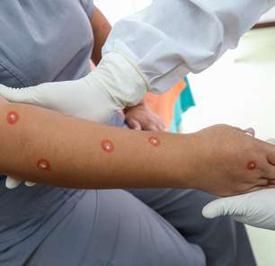 Varíola dos macacos: lesões podem apresentar características variadas e requerem atenção