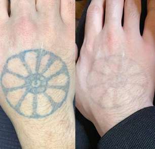 Especialista esclarece dúvidas sobre remoção de tatuagem