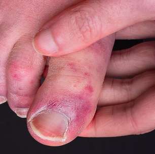 'Dedos de covid': o raro sintoma que atinge mãos e pés