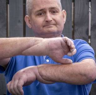 O transplante de mãos que deu 'nova vida' a homem com doença rara