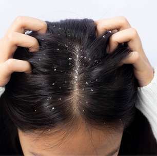 Dermatite seborreica: rosto e couro cabeludo podem ser afetados