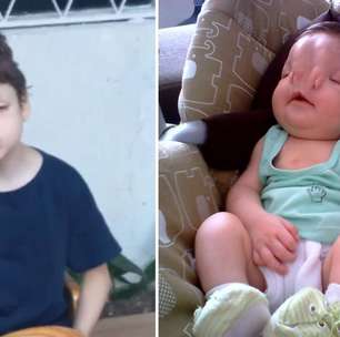 Criança com grave má formação no rosto ganha vaquinha para custear cirurgia emergencial