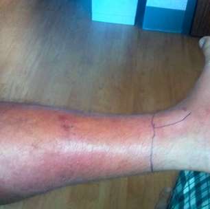 Celulite infecciosa: o que é, sintomas e tratamento