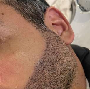 Transplante de barba cresce no mercado masculino