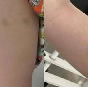 Caso Naiara Azevedo: fotos mostram hematomas causados pelo ex