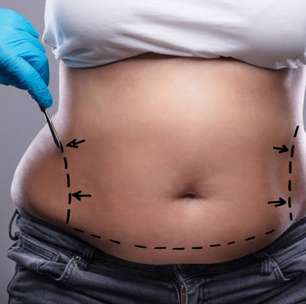 Cirurgia de abdominoplastia é considerada segura e confiável