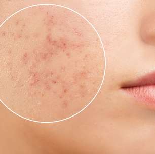 Acne e saúde mental: saiba qual a relação entre elas